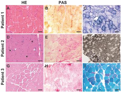 Expanding the clinicopathological-genetic spectrum of glycogen storage disease type IXd by a Chinese neuromuscular center